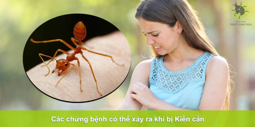 kiến cắn