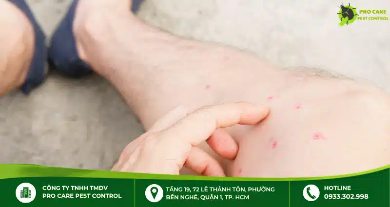 Dấu hiệu bọ chét cắn ở chân